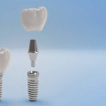 Dental Implant, Dental Equipment, Human Teeth, Implant, Installing