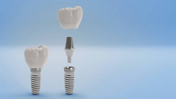 Dental Implant, Dental Equipment, Human Teeth, Implant, Installing